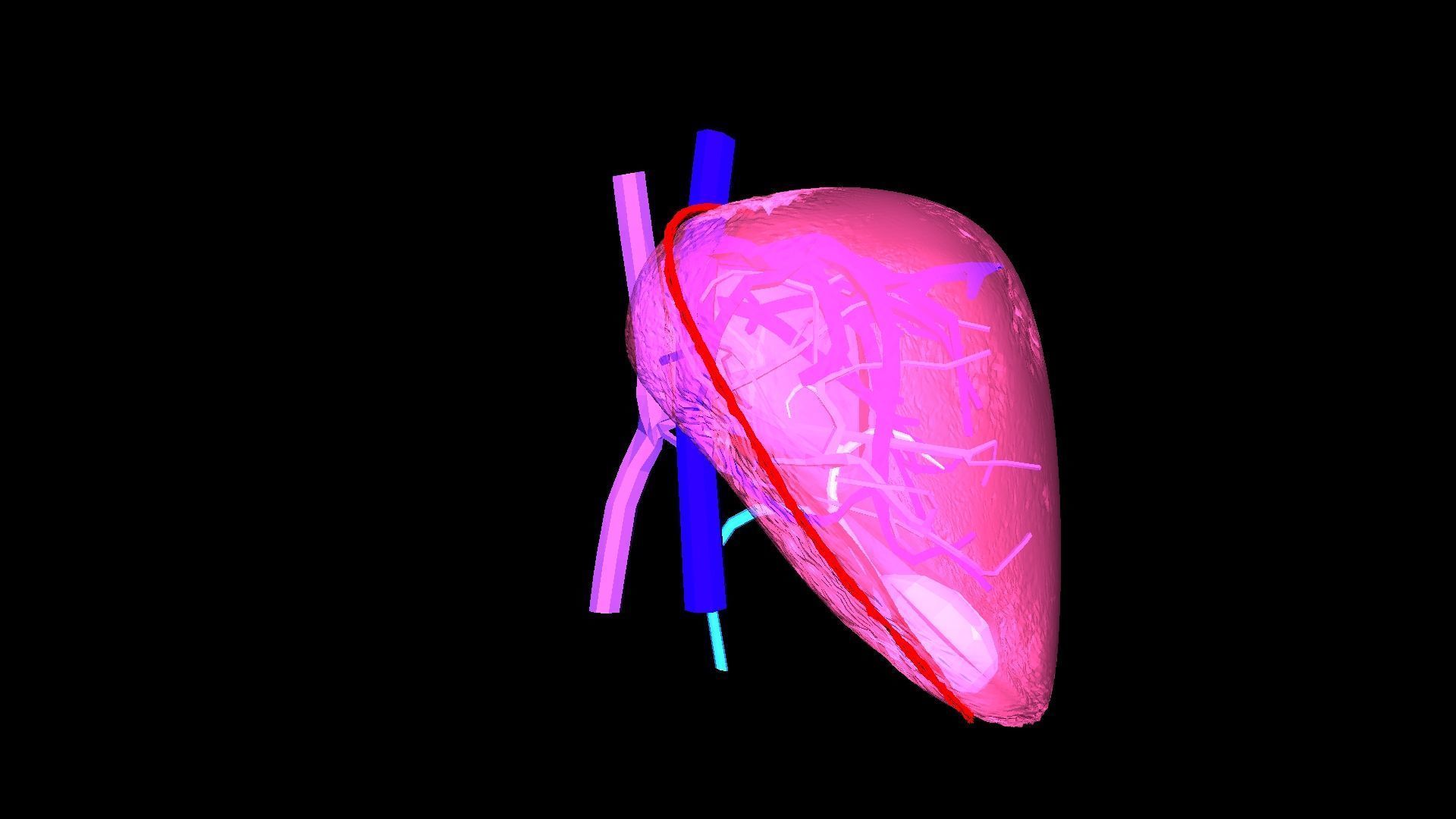 3D Model of Liver with Steatosis 3D model_9
