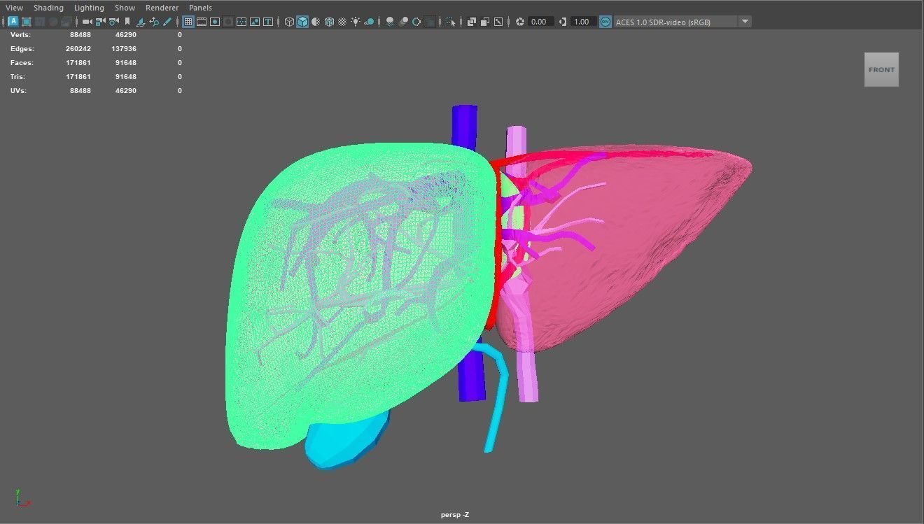 3D Model of Liver with Steatosis 3D model_2