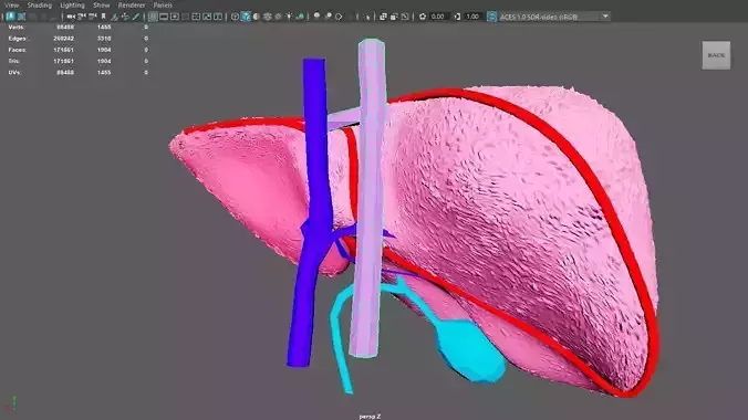 3D Model of Liver with Non-alchocolic steatohepatitis - NASH