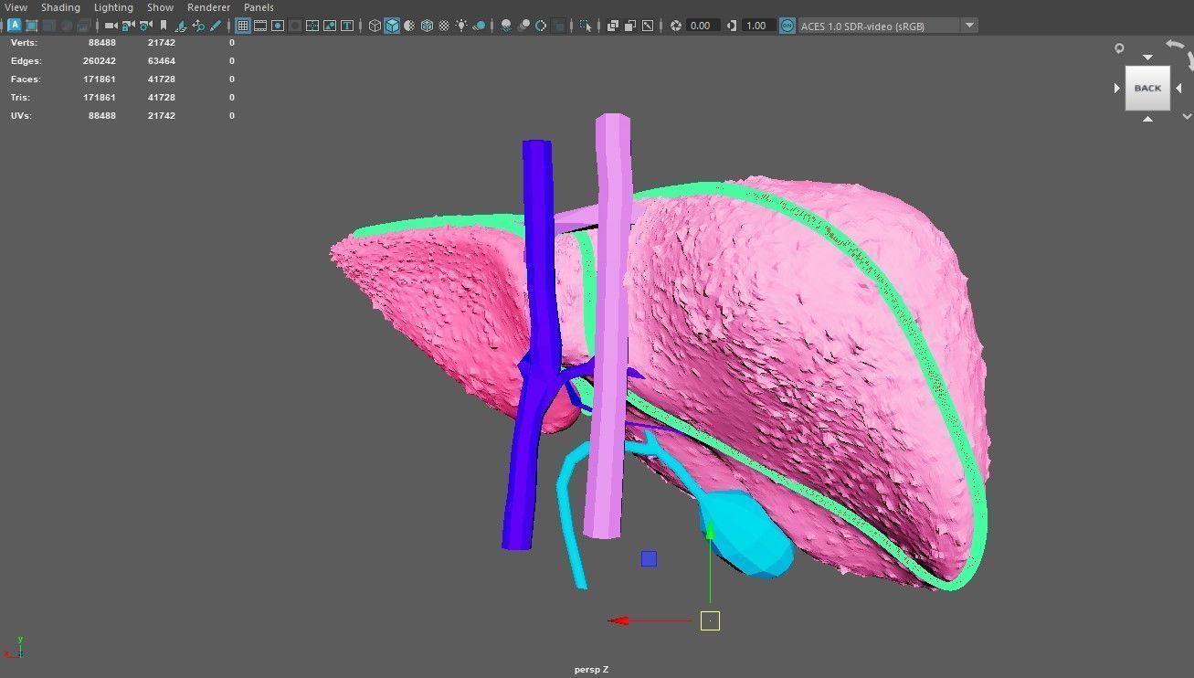 3D Model of Liver with Cirrhosis 3D model_1