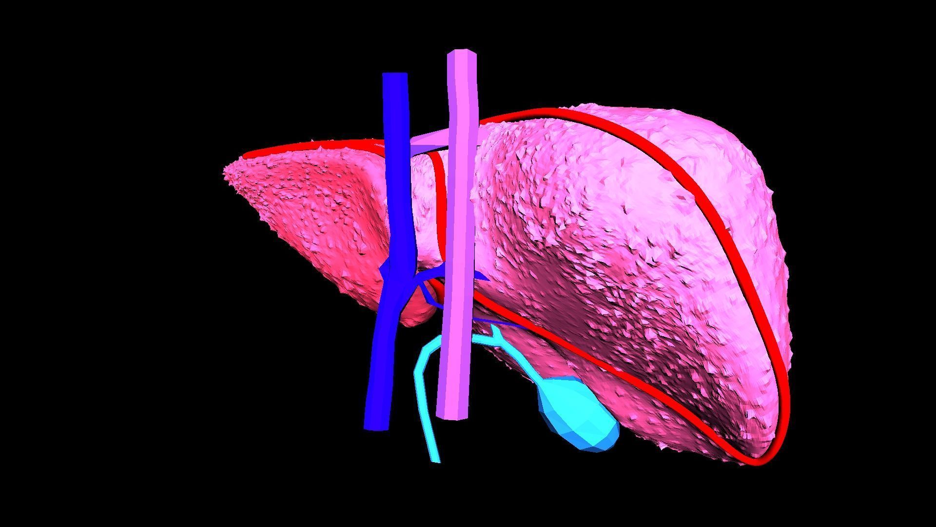 3D Model of Liver with Cirrhosis 3D model_13