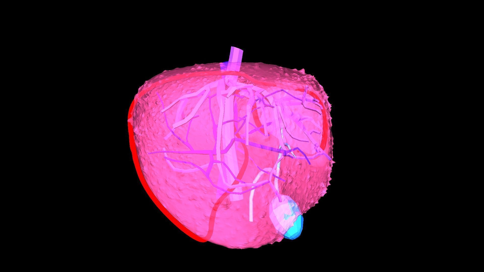 3D Model of Liver with Cirrhosis 3D model_11