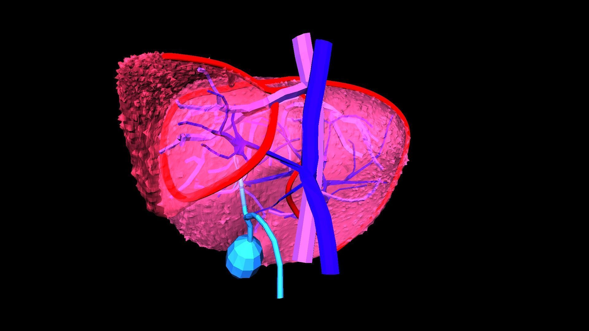 3D Model of Liver with Cirrhosis 3D model_9