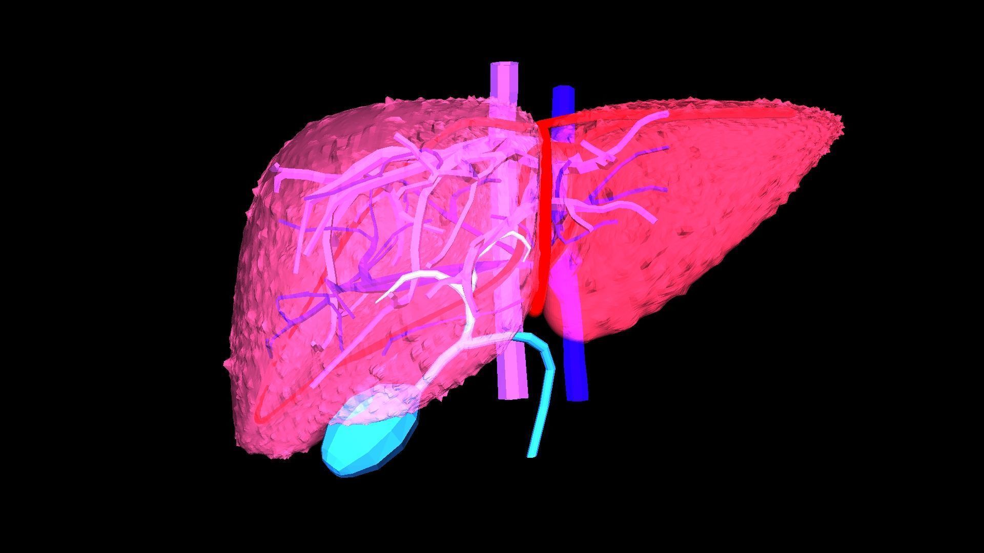 3D Model of Liver with Cirrhosis 3D model_8