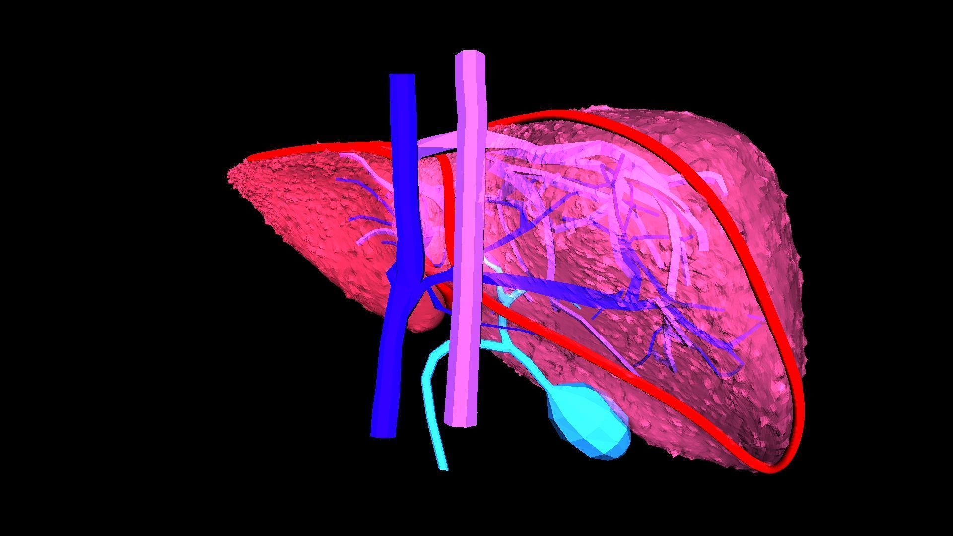 3D Model of Liver with Cirrhosis 3D model_10