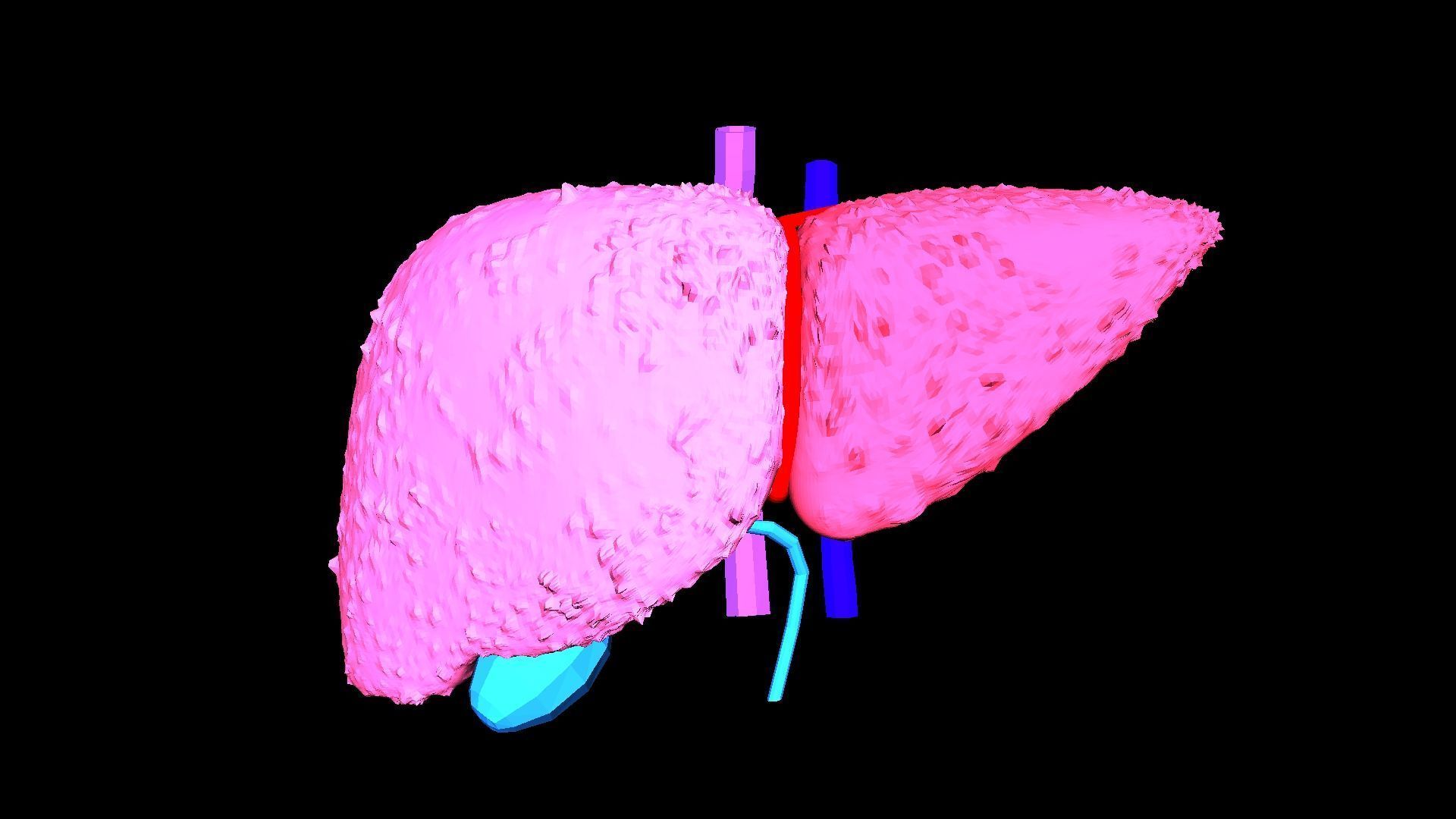 3D Model of Liver with Cirrhosis 3D model_7