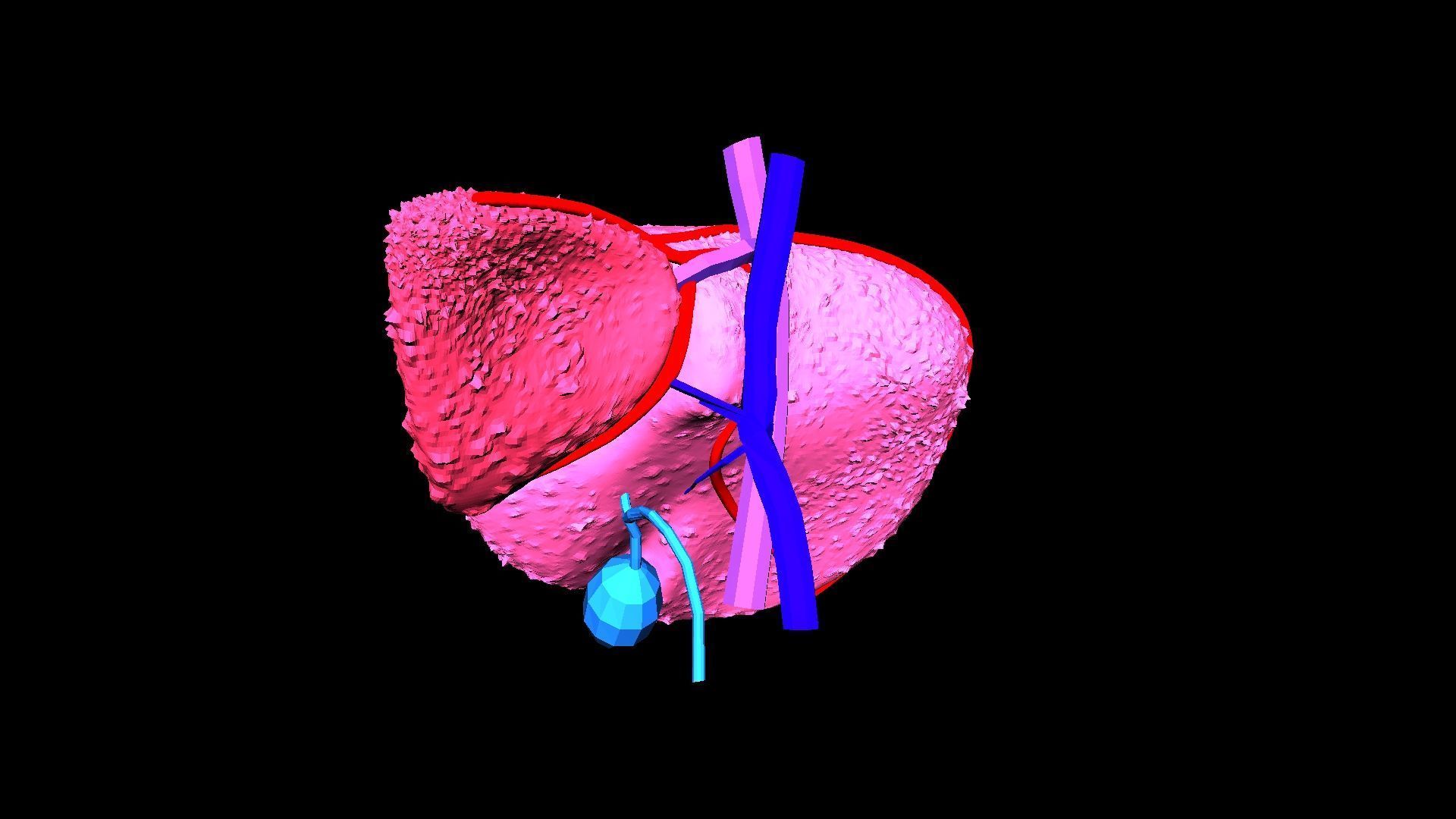 3D Model of Liver with Cirrhosis 3D model_12