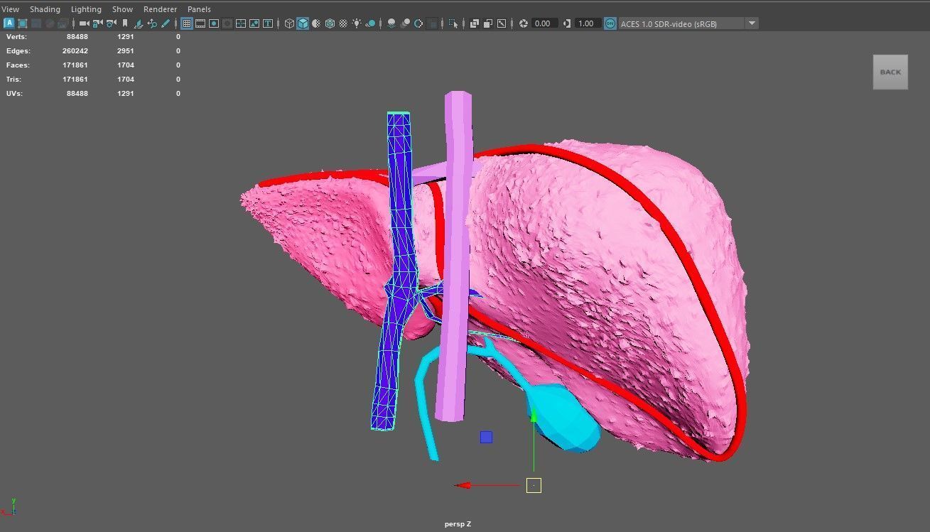 3D Model of Liver with Cirrhosis 3D model_6