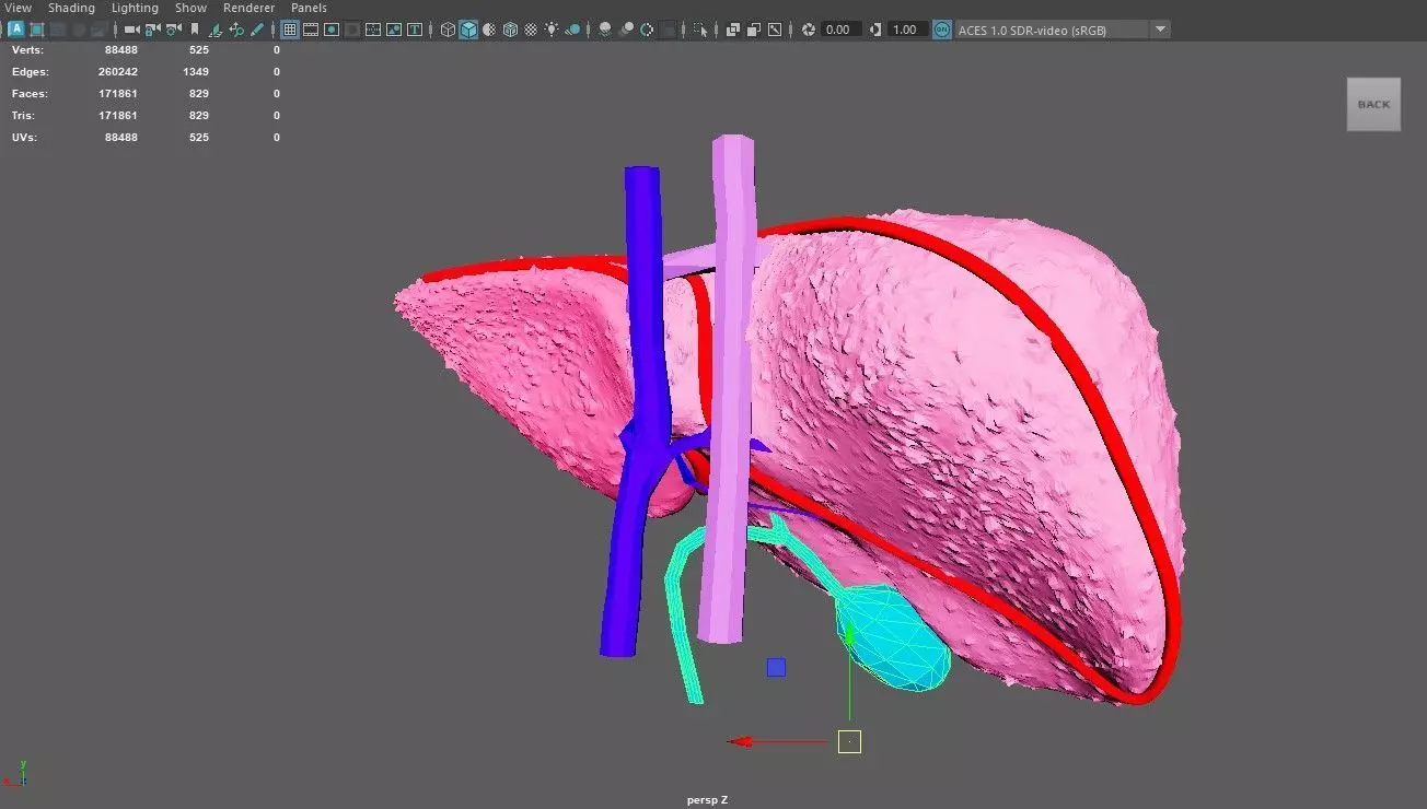 3D Model of Liver with Cirrhosis 3D model_0