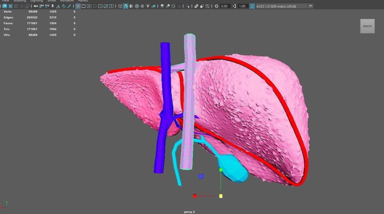 3D Model of Liver with Cirrhosis 3D model_5