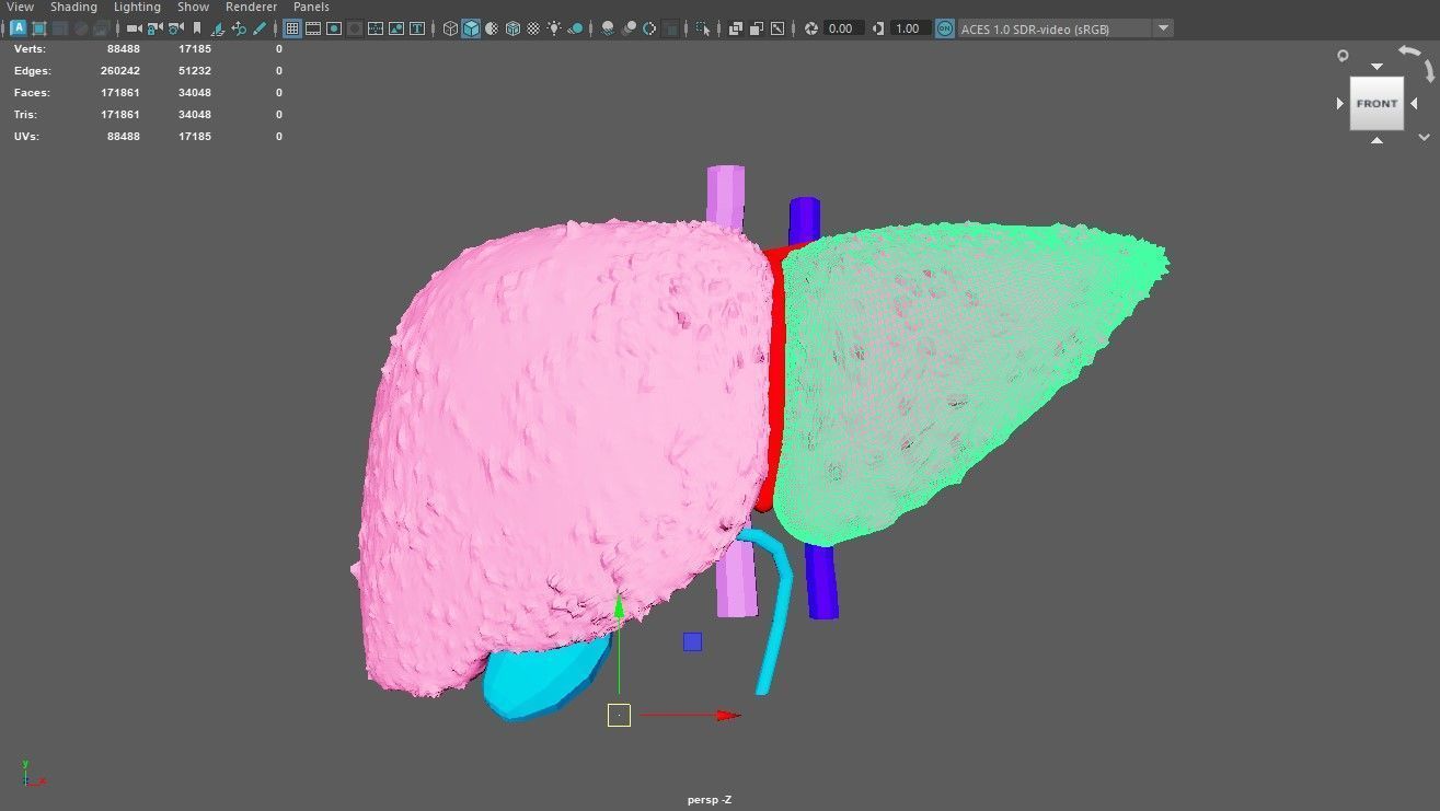 3D Model of Liver with Cirrhosis 3D model_4