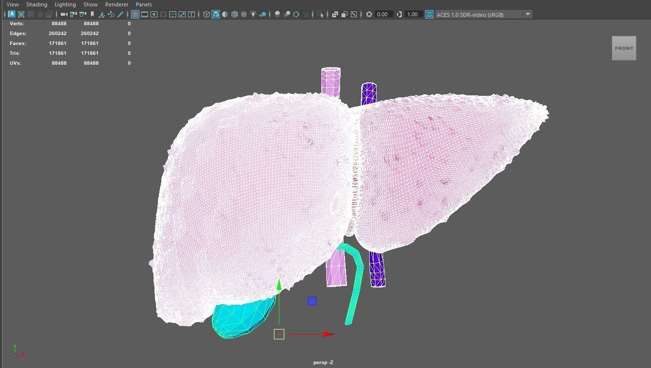 3D Model of Liver with Cirrhosis 3D model_2