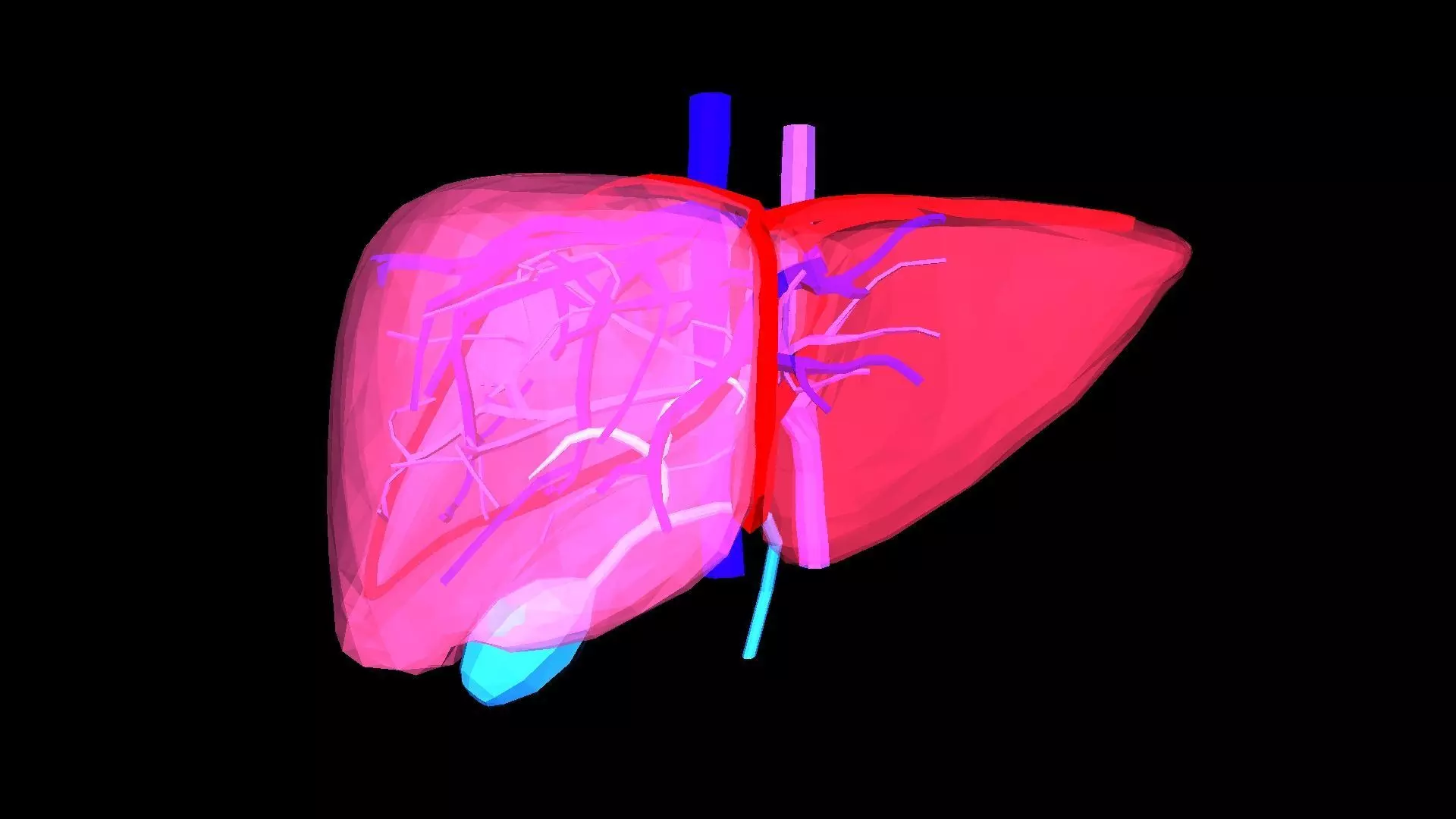 3D Models of Liver Disease - bundle - 6 pack 3D model