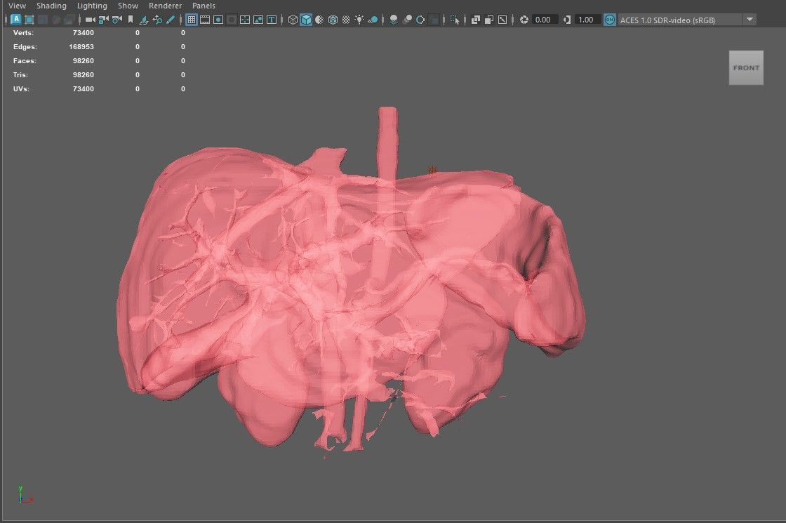 3D Model of Pre- and Post- Operative Liver 3D model_5