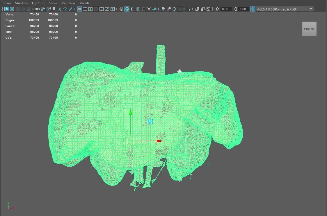 3D Model of Pre- and Post- Operative Liver 3D model_6