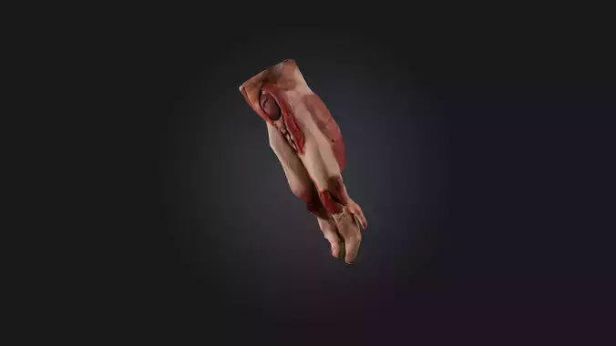 Infected Thigh Muscle