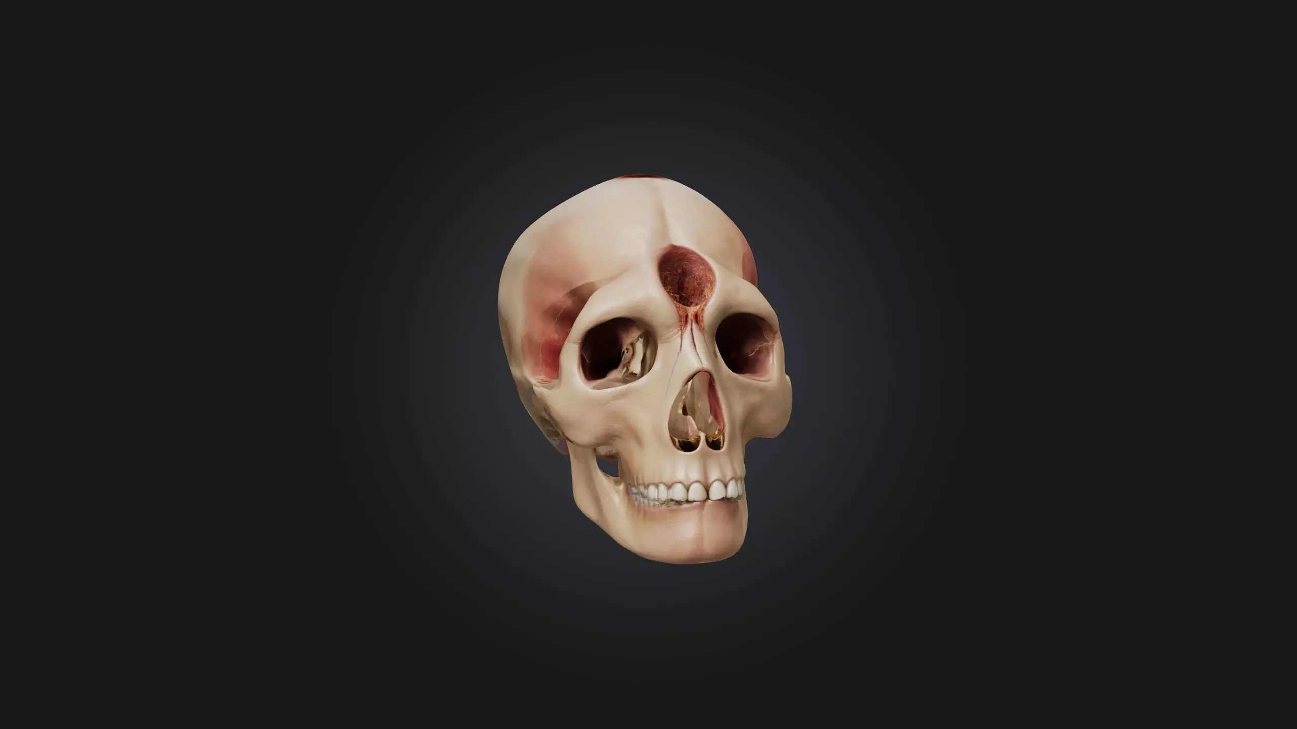 Infected Sinus Low-poly 3D model_0