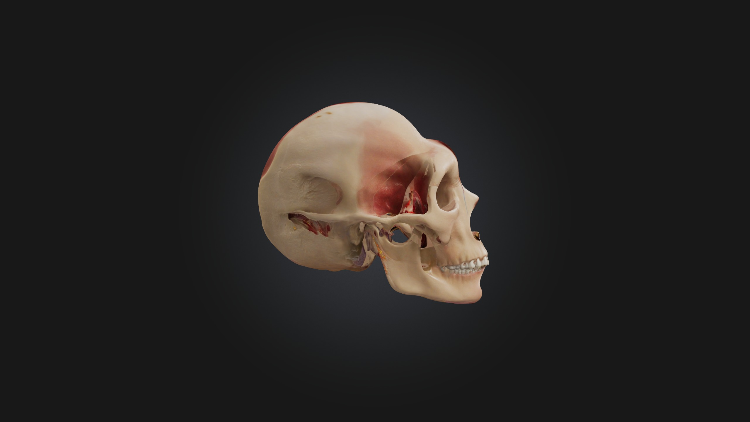 Infected Sinus Low-poly 3D model_1