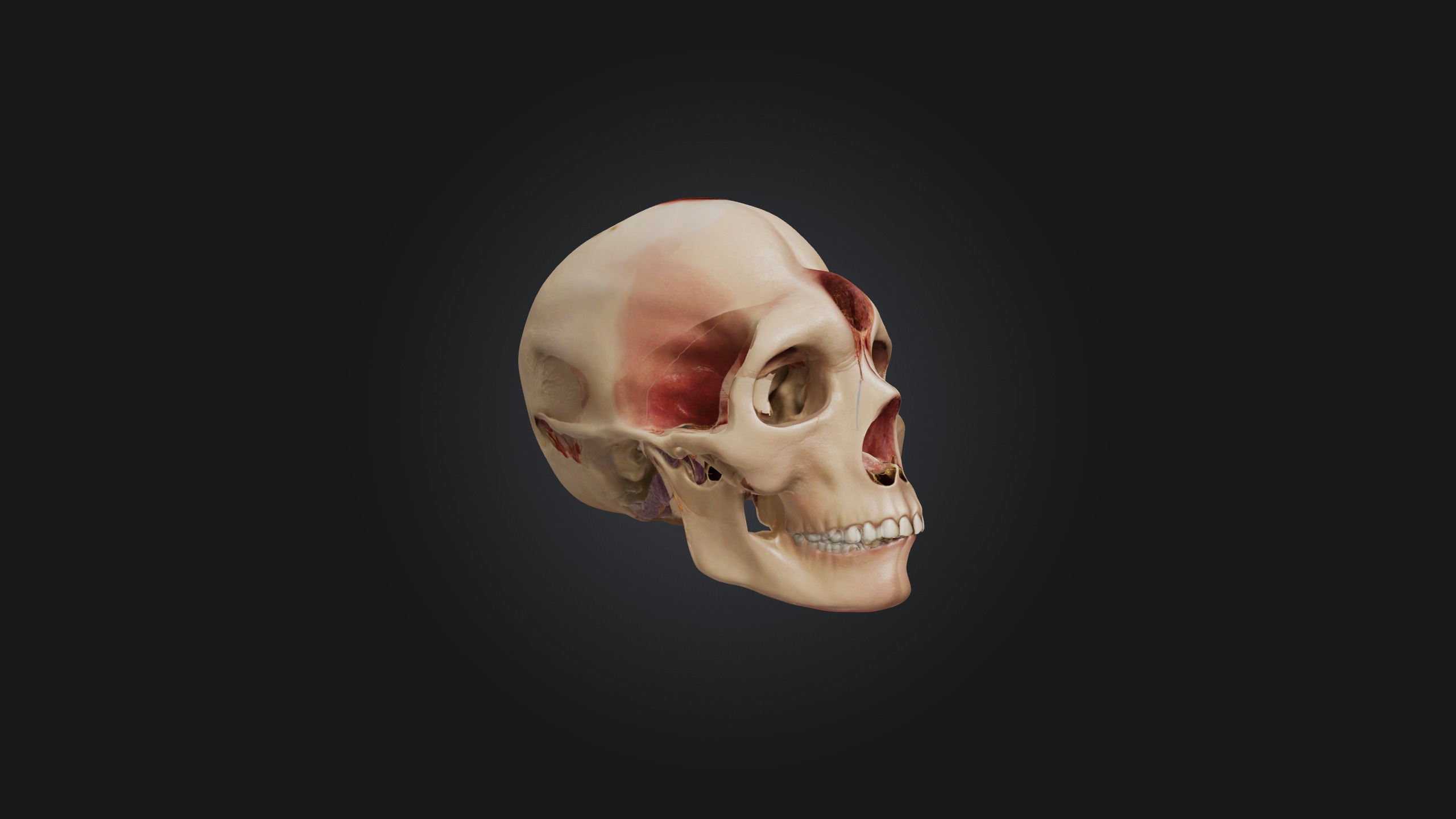 Infected Sinus Low-poly 3D model_5