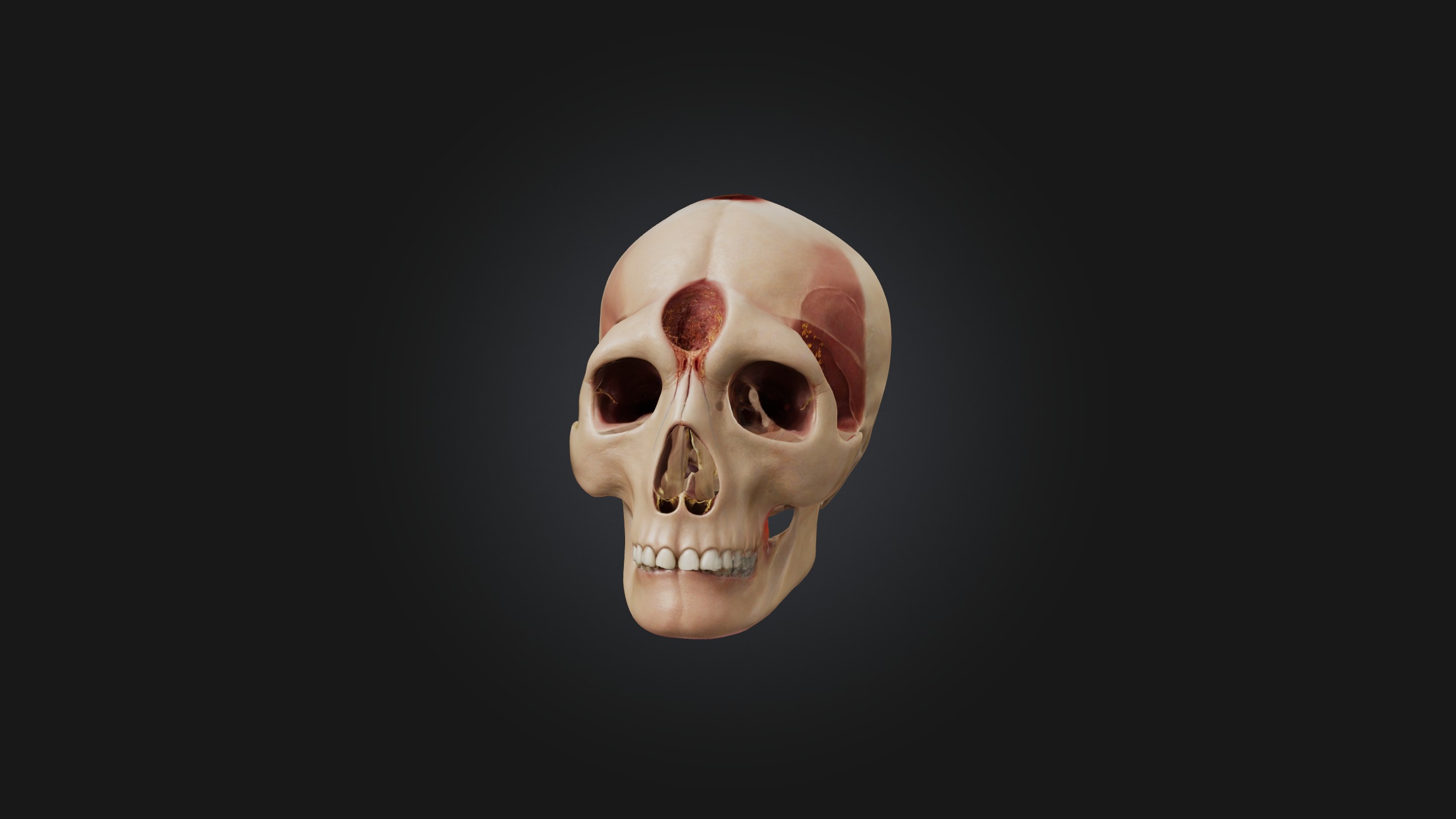 Infected Sinus Low-poly 3D model_3