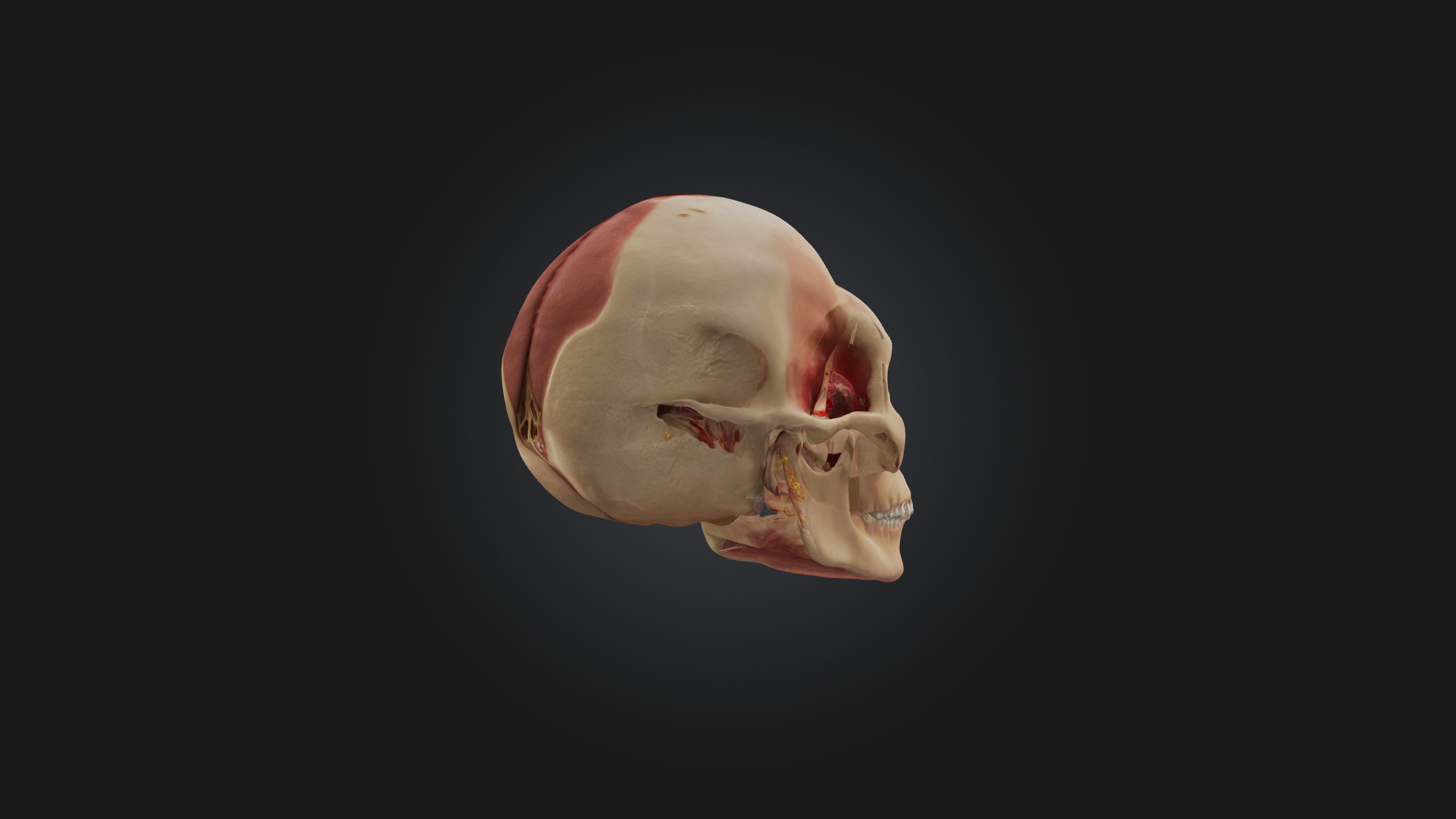Infected Sinus Low-poly 3D model_6