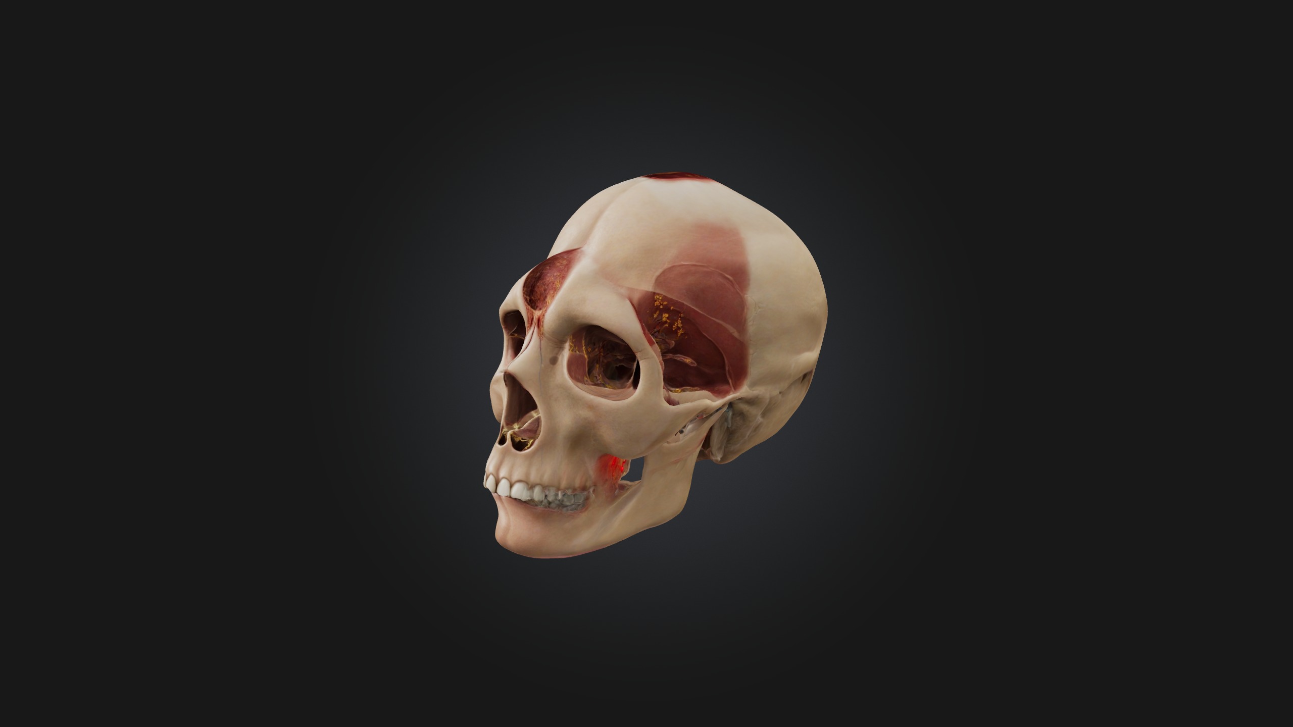 Infected Sinus Low-poly 3D model_2