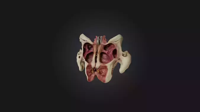 Infected Pelvis