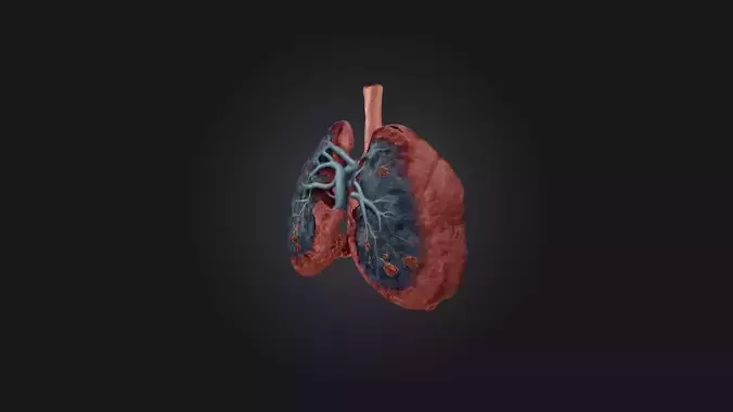 Infected Lung