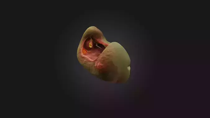 Infected Gallbladder