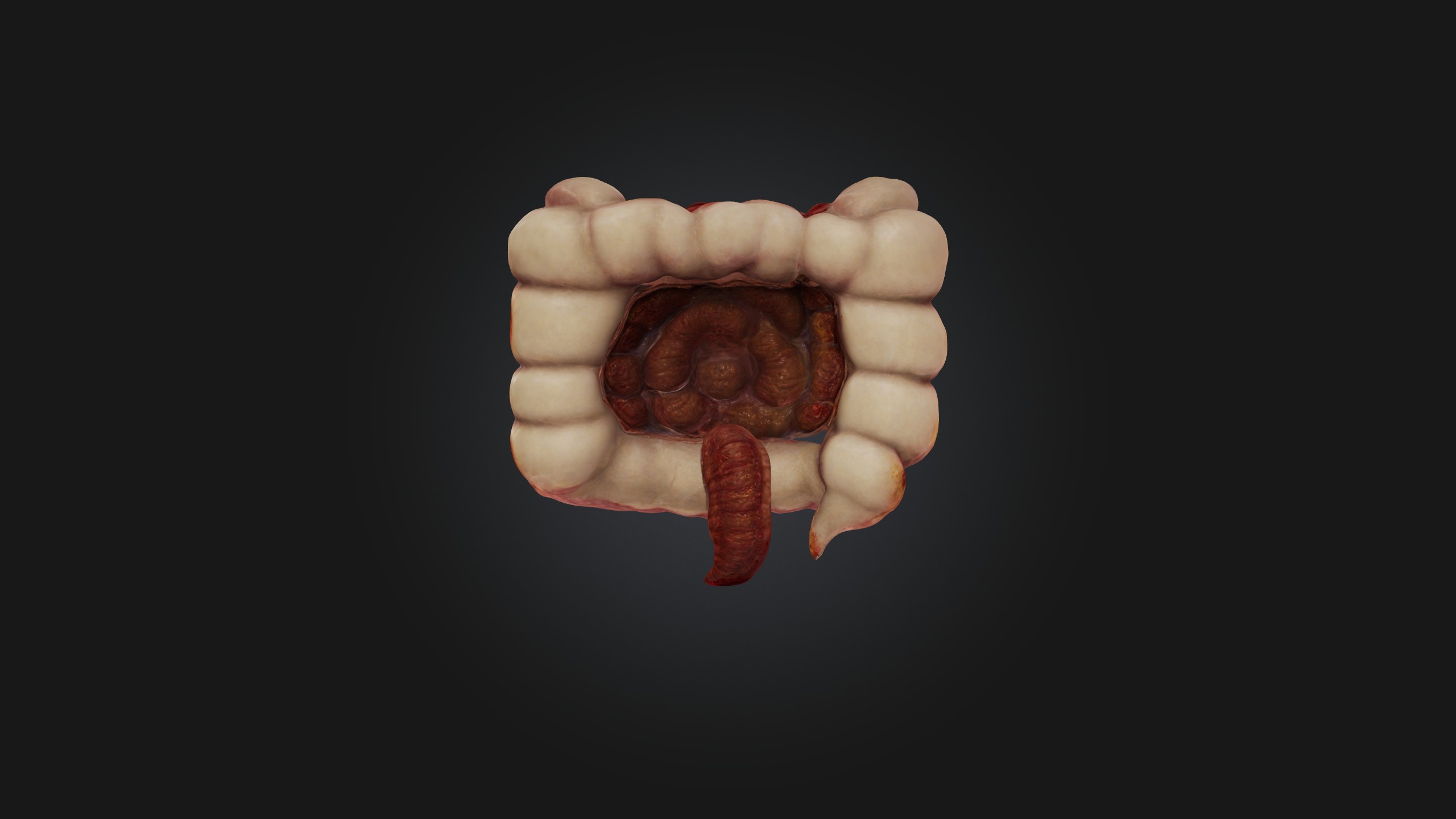 Infected Colon Low-poly 3D model_5