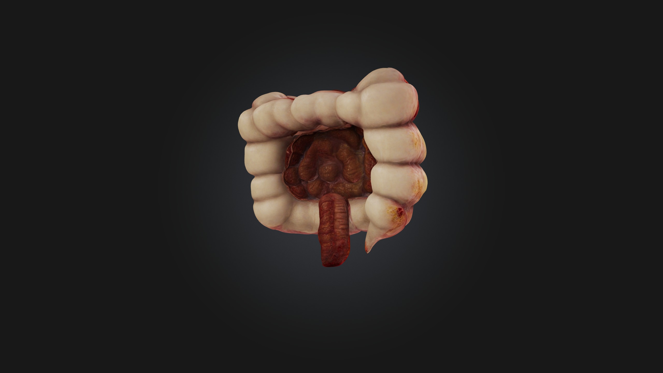 Infected Colon Low-poly 3D model_2