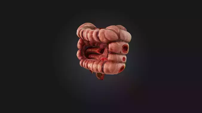 Infected Colon