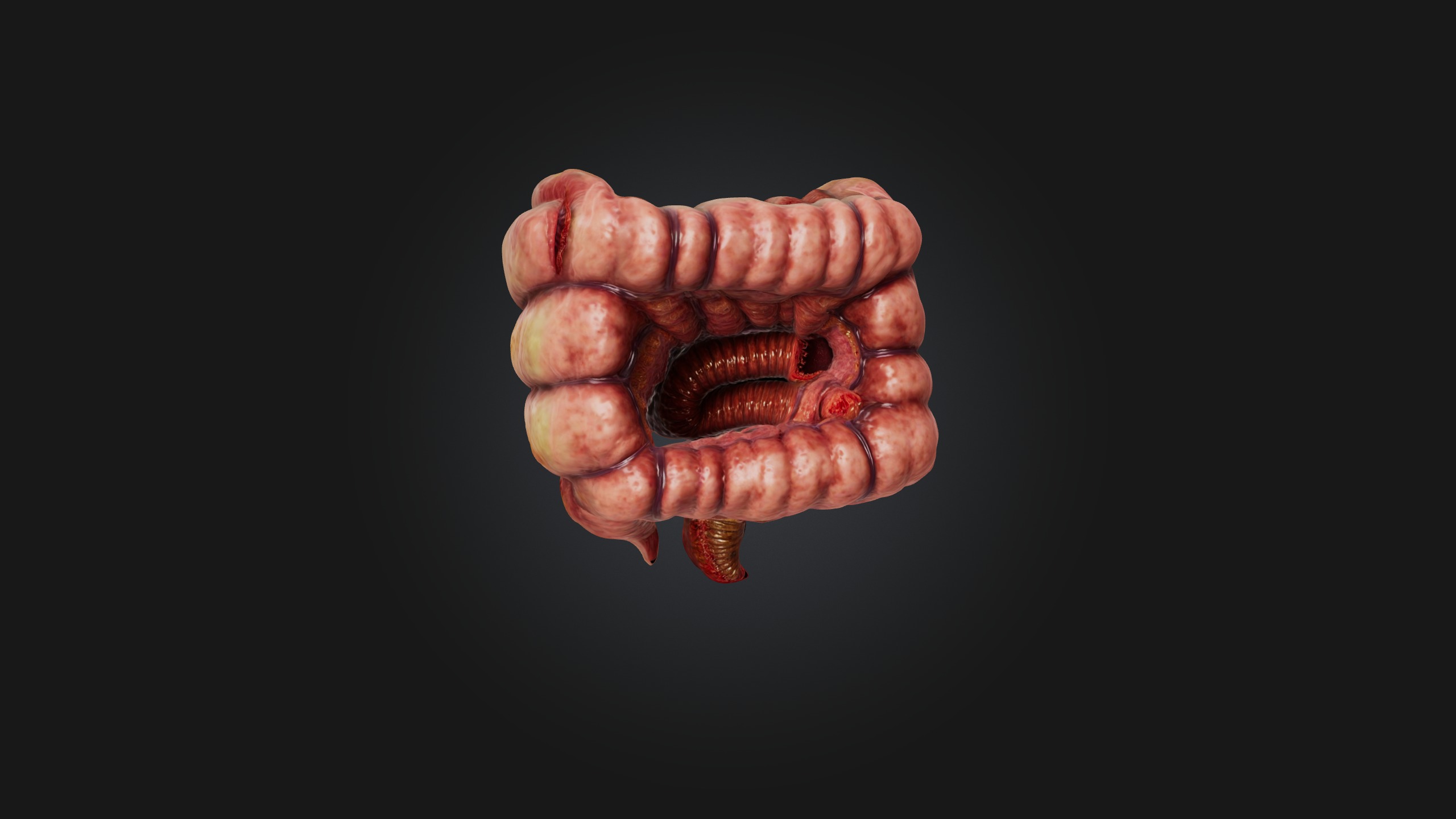 Infected Colon Low-poly 3D model_1