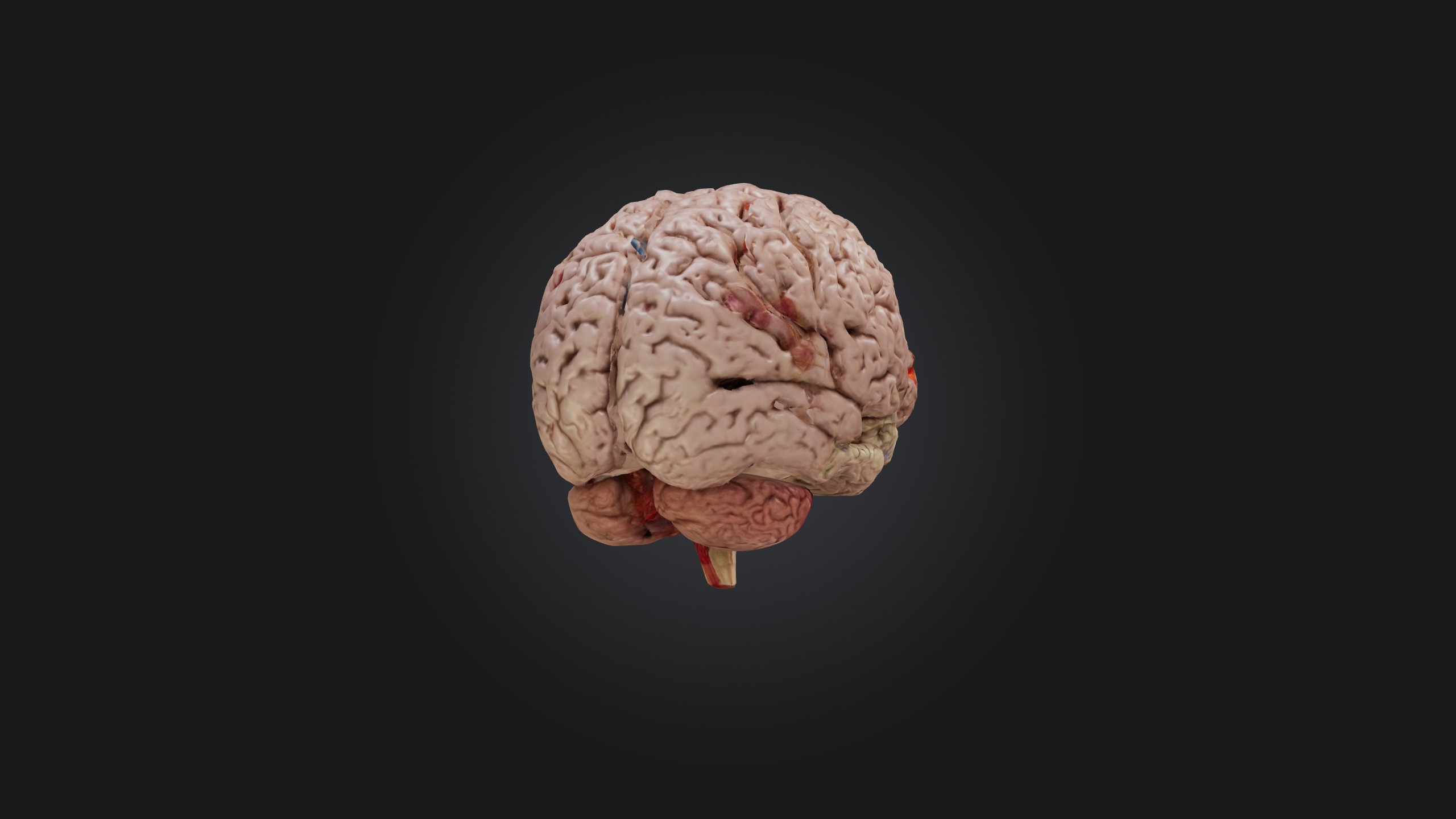 Diseased Brain Low-poly 3D model_7