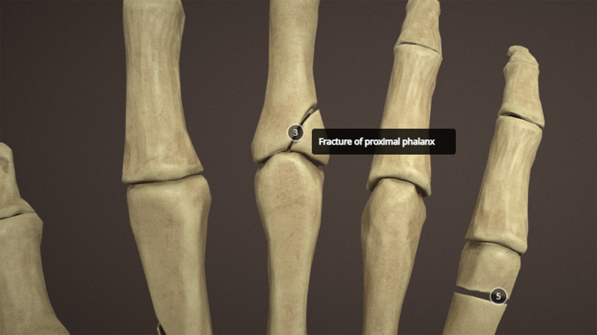 Anatomy of a hand fractures Low-poly 3D model_8