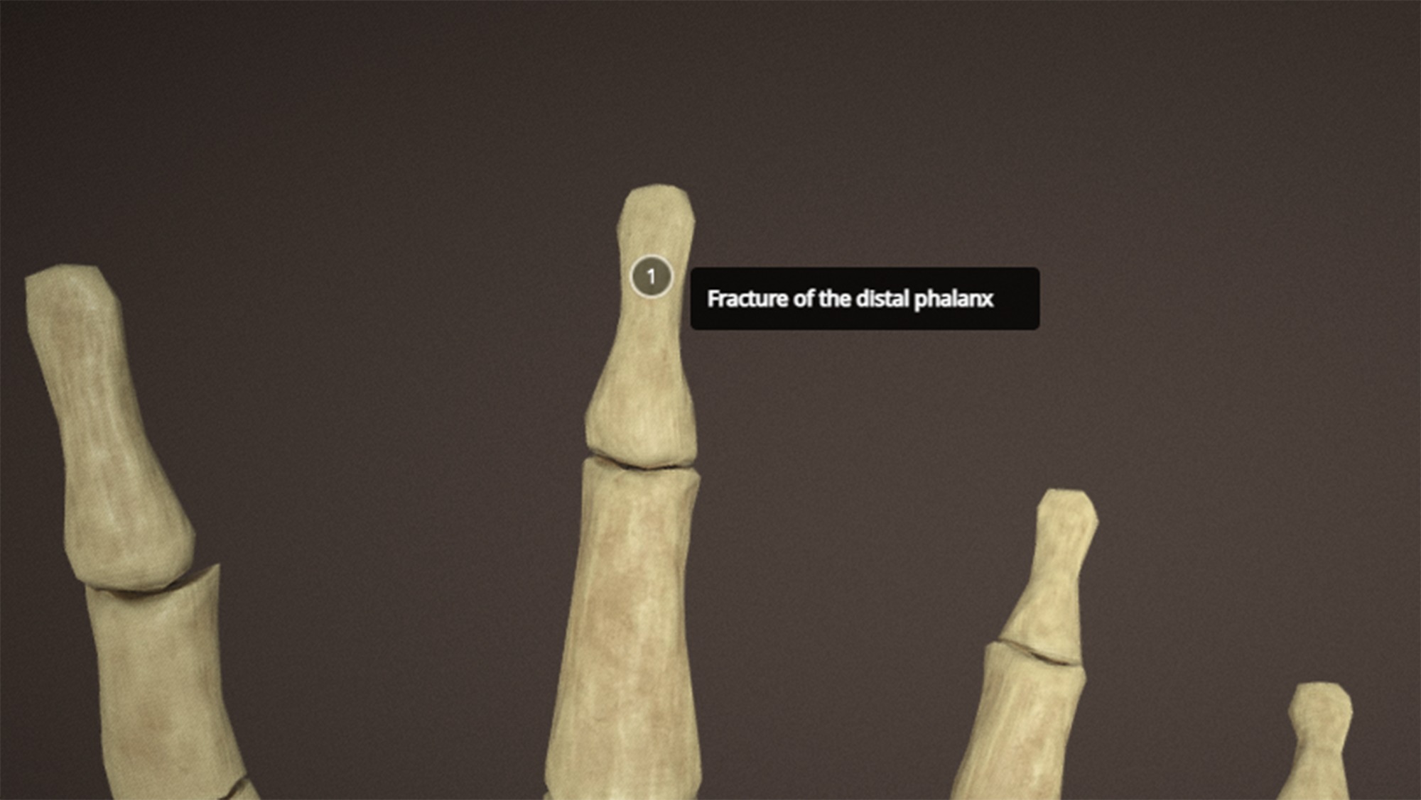 Anatomy of a hand fractures Low-poly 3D model_6