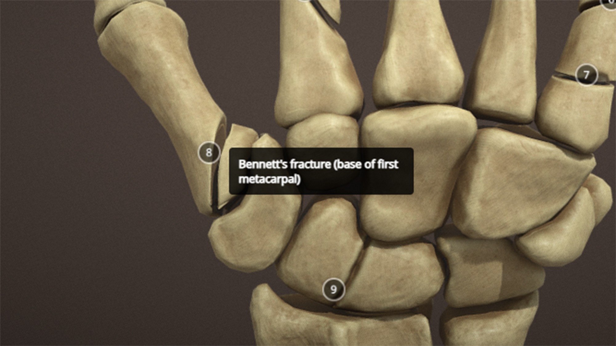 Anatomy of a hand fractures Low-poly 3D model_13