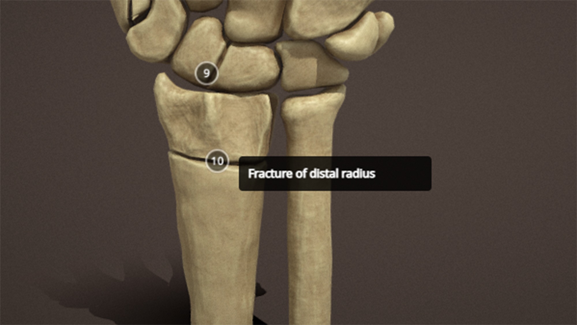 Anatomy of a hand fractures Low-poly 3D model_15