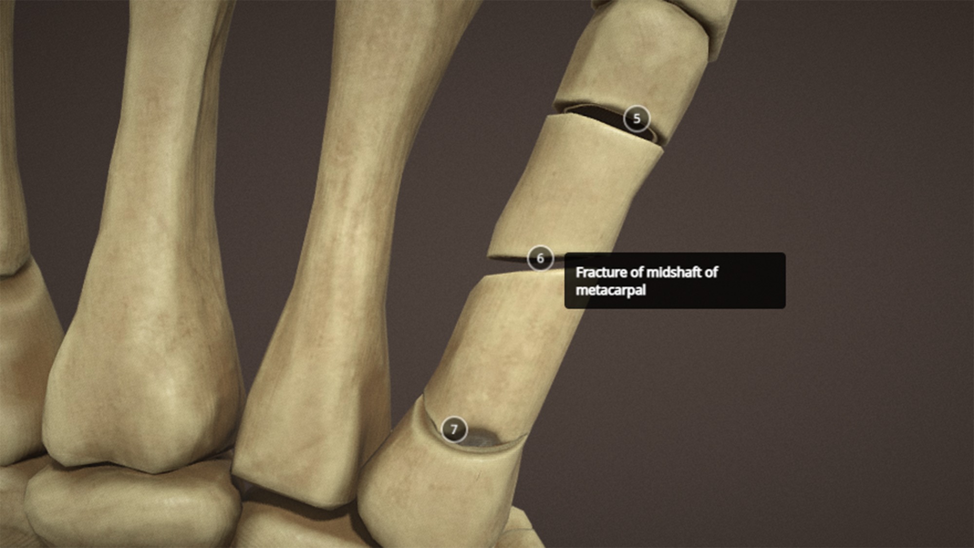 Anatomy of a hand fractures Low-poly 3D model_11