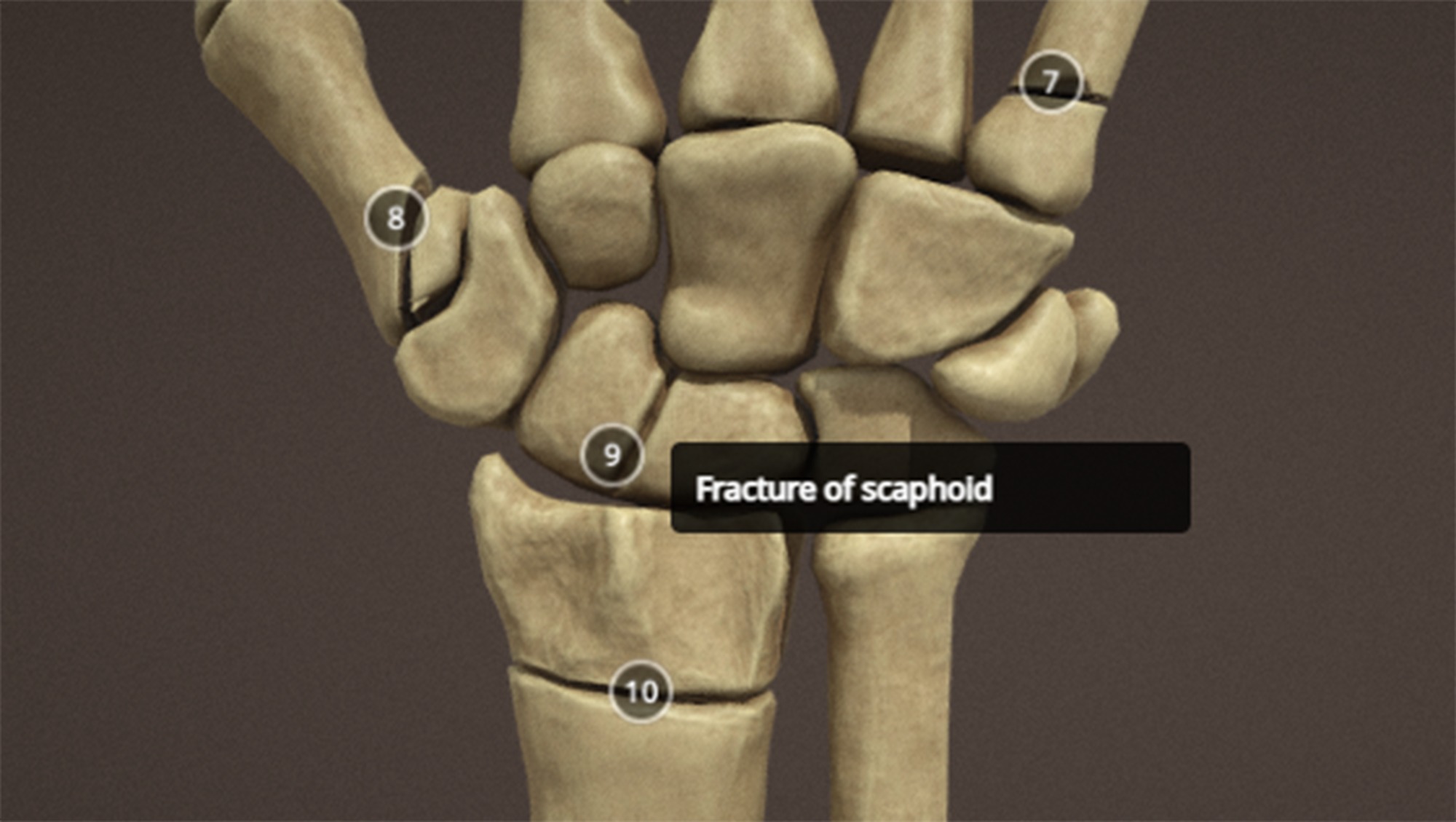 Anatomy of a hand fractures Low-poly 3D model_14