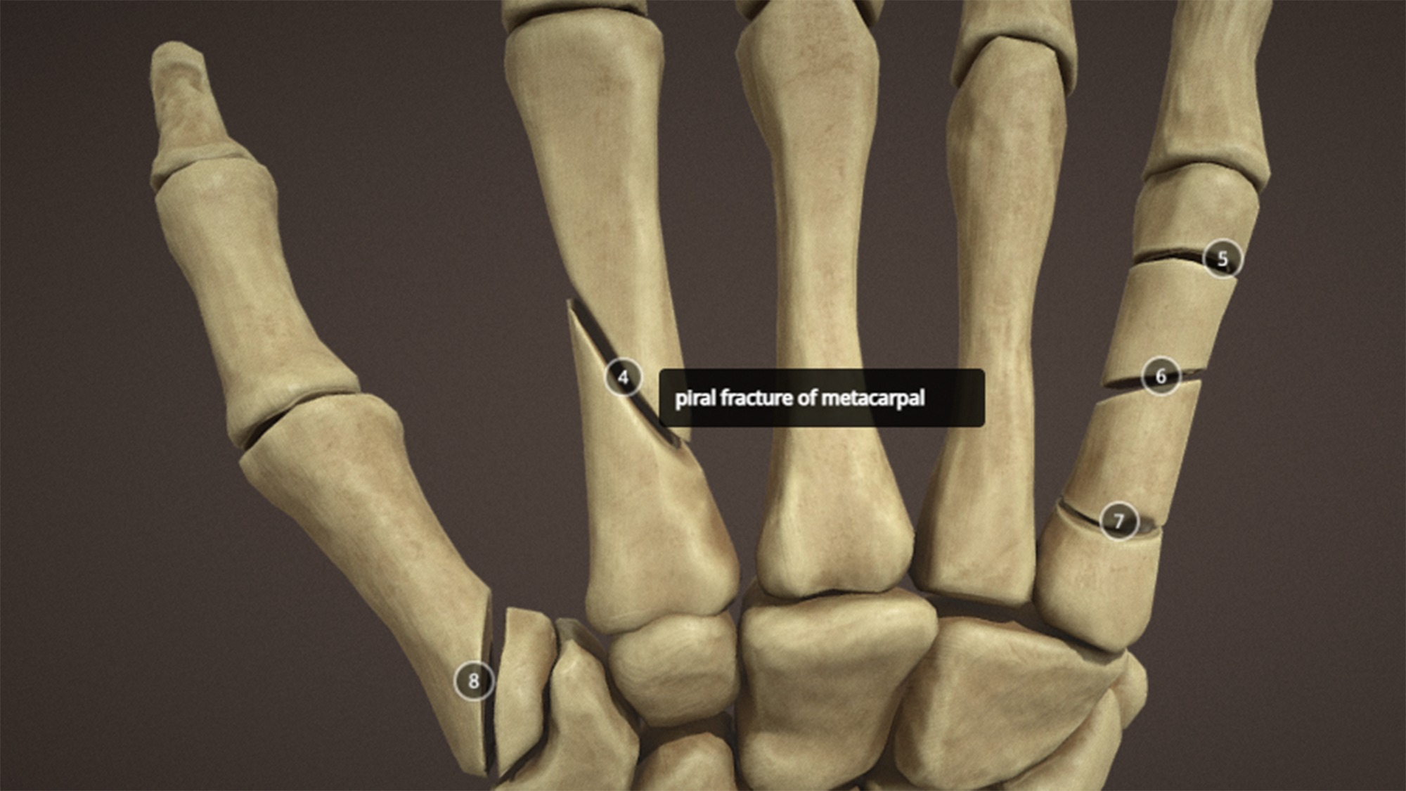 Anatomy of a hand fractures Low-poly 3D model_9