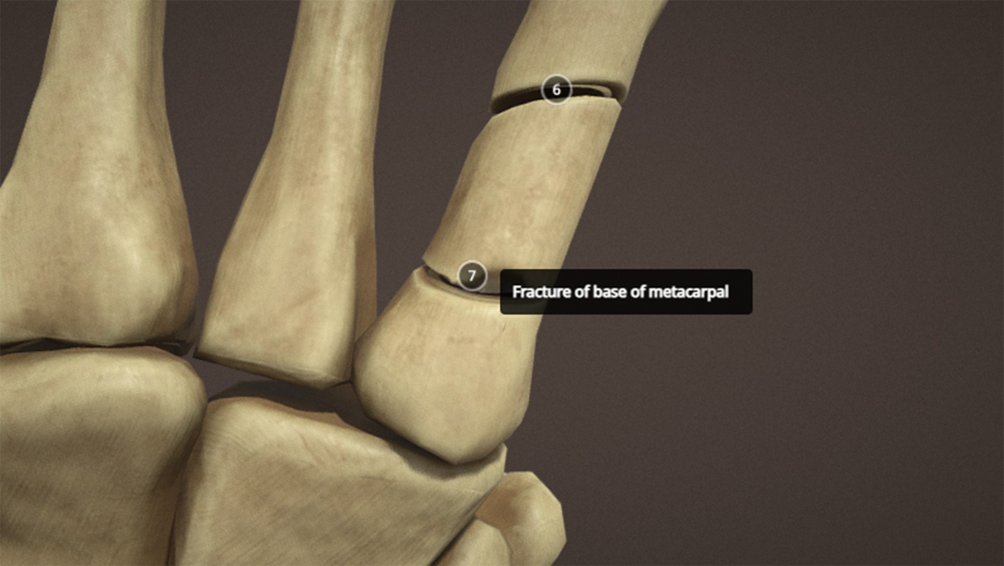 Anatomy of a hand fractures Low-poly 3D model_12