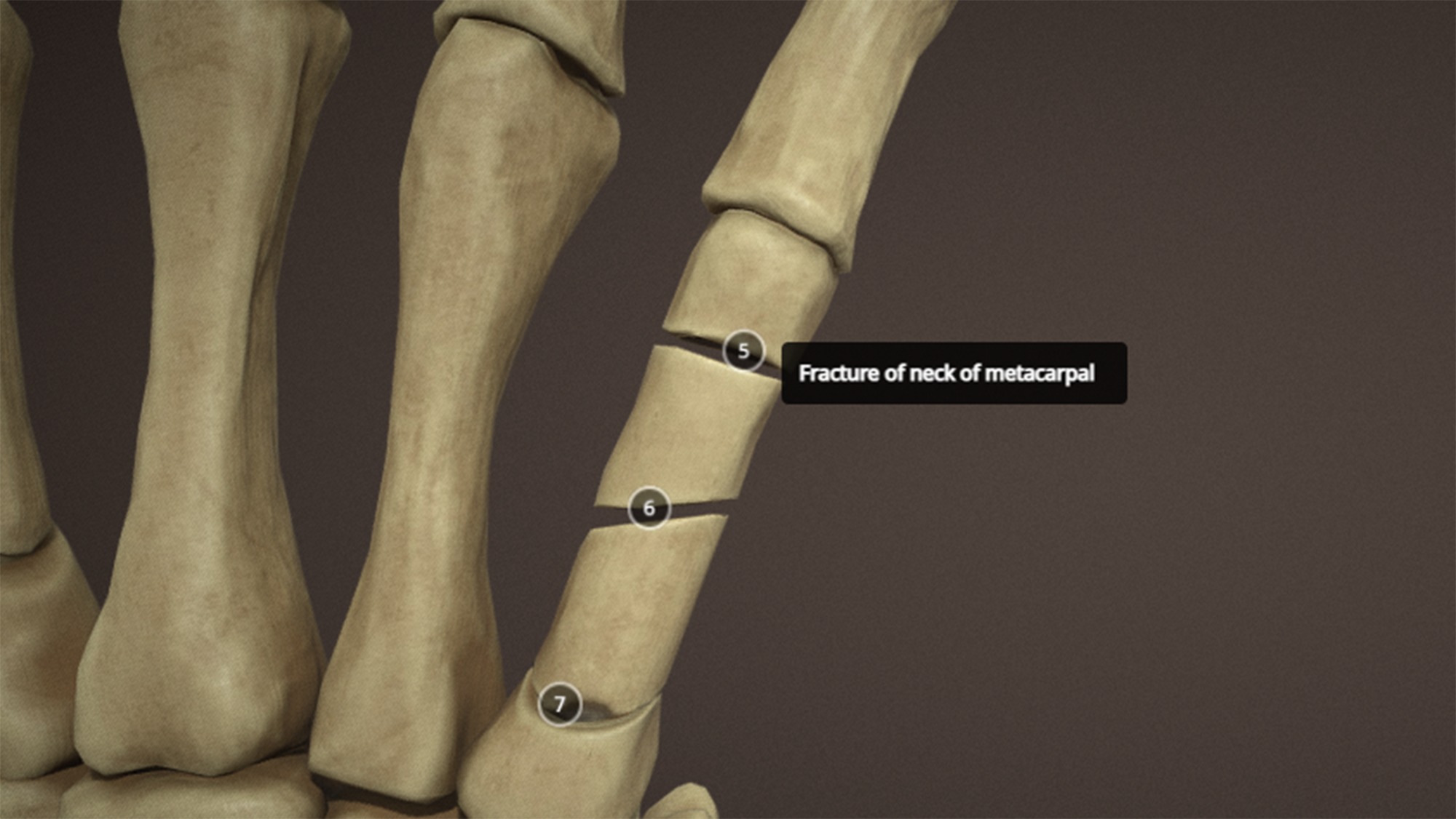 Anatomy of a hand fractures Low-poly 3D model_10