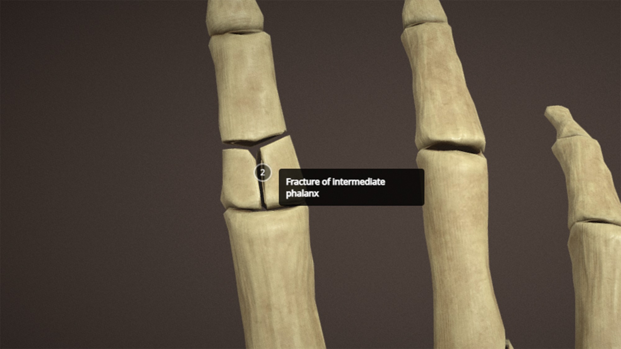 Anatomy of a hand fractures Low-poly 3D model_7