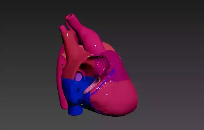 3D Model of Heart with Atrial Septal Defect 3D model
