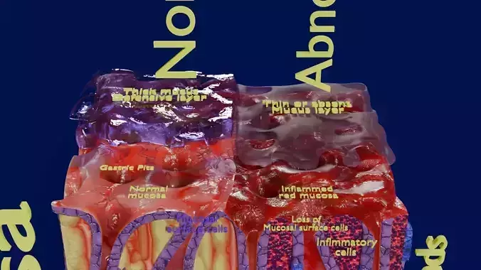 Stomach Gastric acid peptic disease ulcer Low-poly 3D model