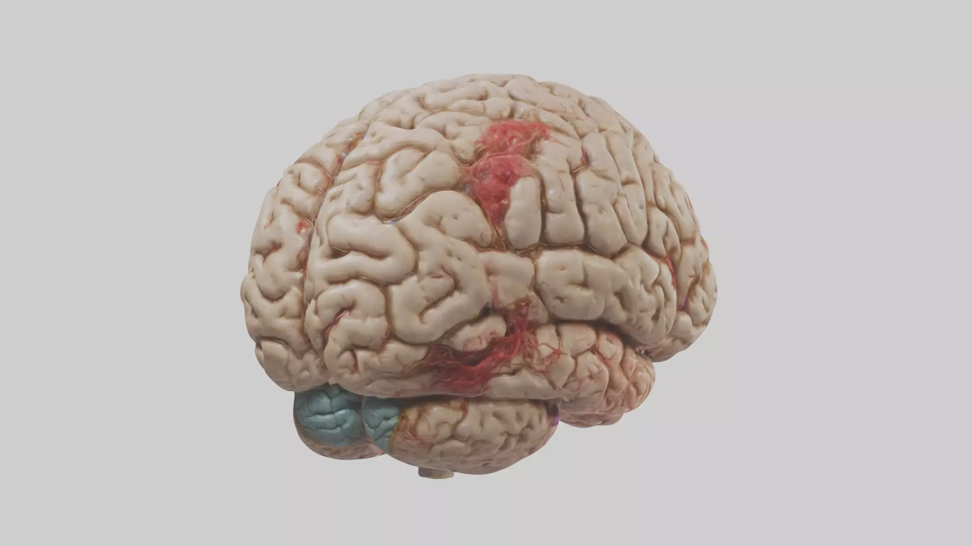 Infected Brain Model  3D model_0