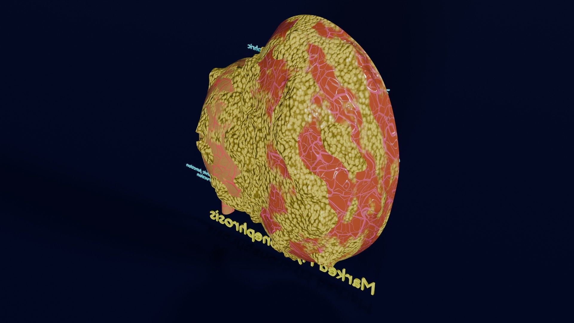 Hydronephrosis marked kidney renal Low-poly 3D model_35