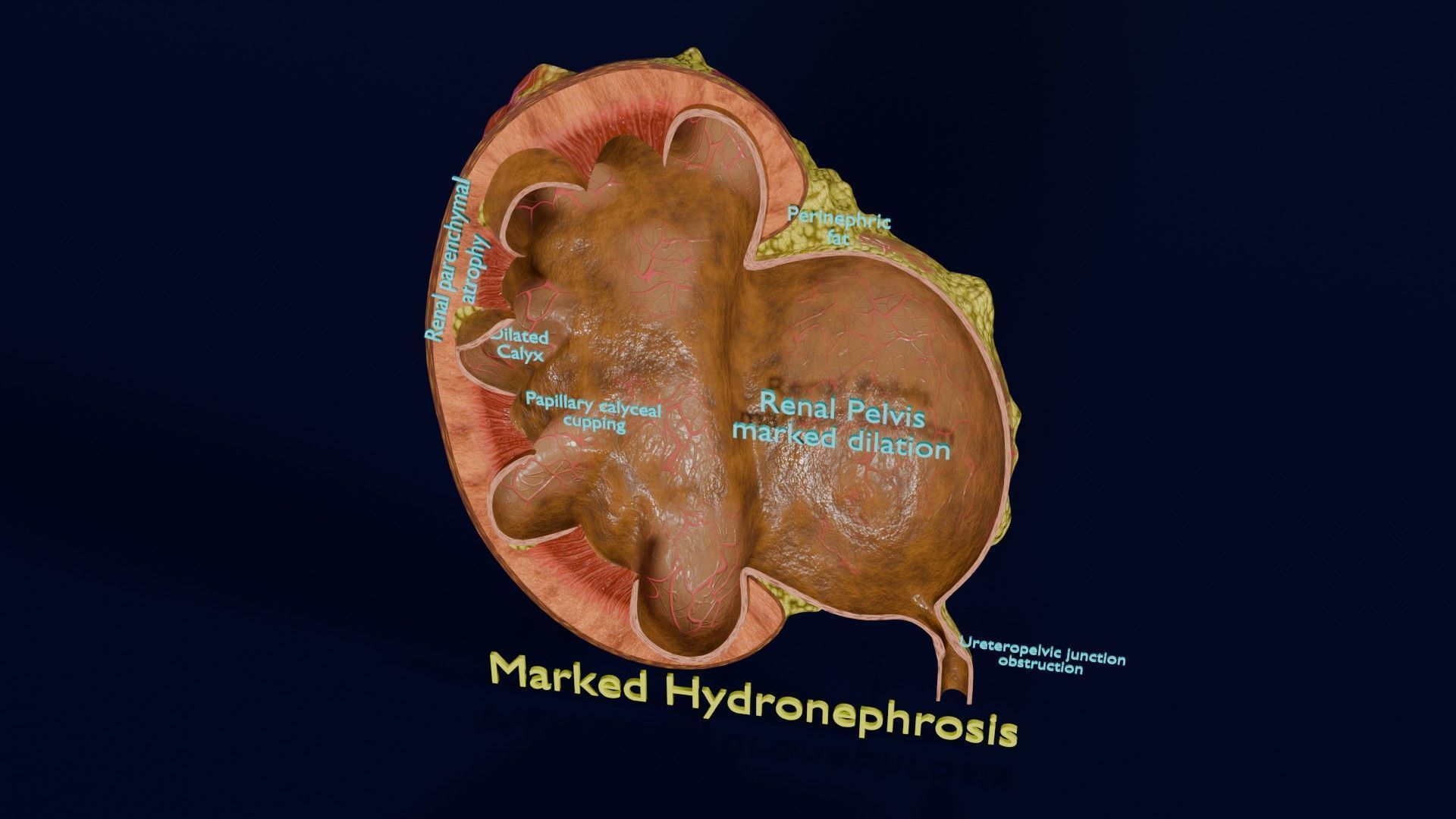 Hydronephrosis marked kidney renal Low-poly 3D model_50