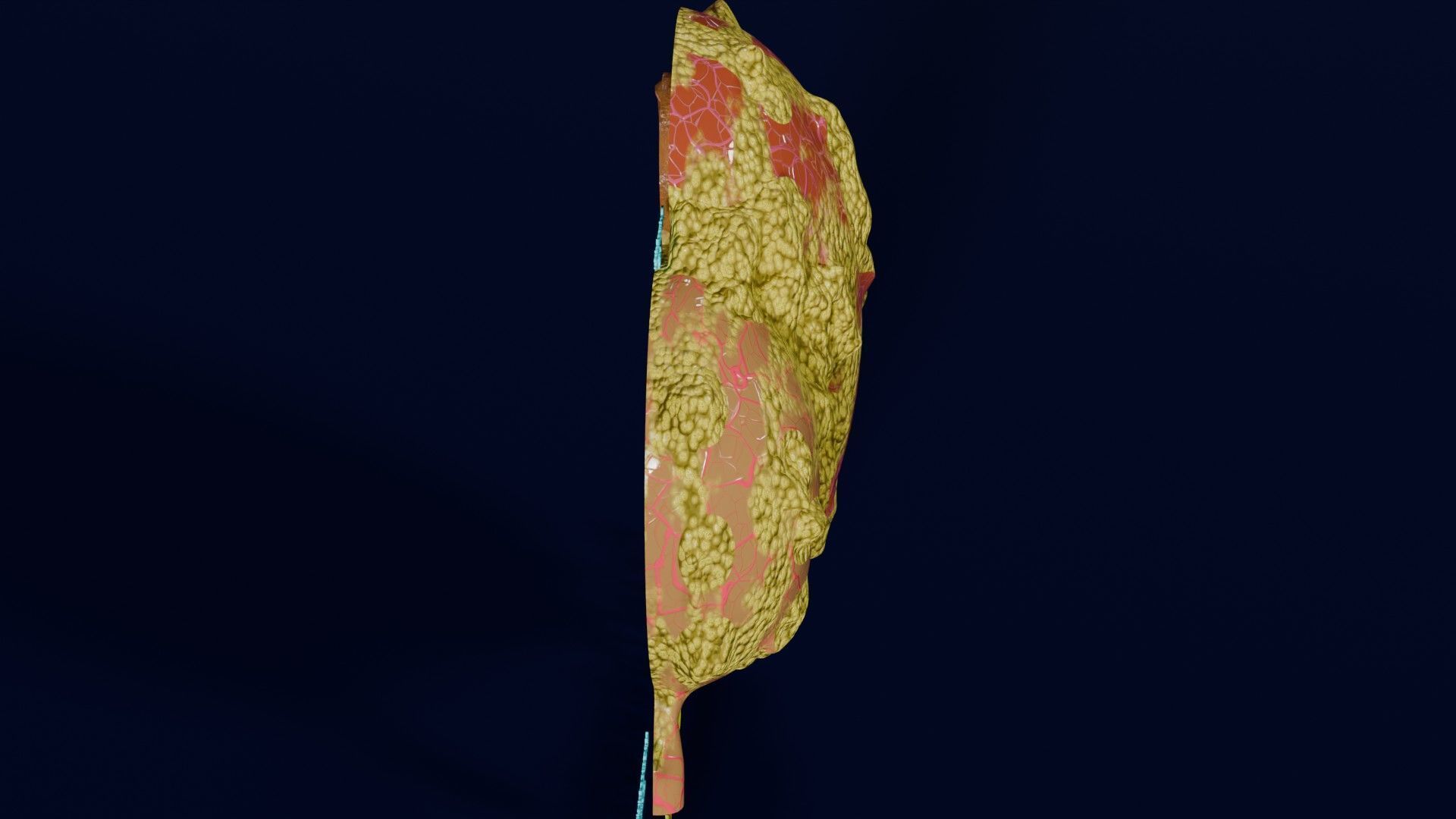 Hydronephrosis marked kidney renal Low-poly 3D model_45